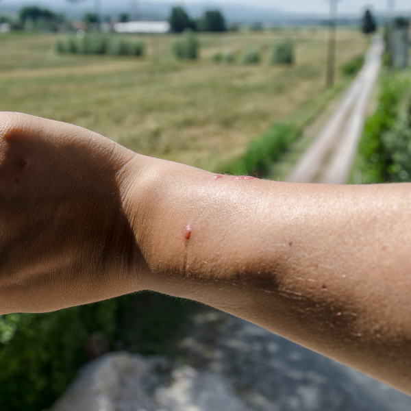 The image depicts a person's forearm with a spider bite. The bite appears as a small, raised red bump on the skin, with slight inflammation around it. The arm is positioned against a blurred background of a rural landscape, showing fields and a dirt road, indicating the photo was taken outdoors. The lighting suggests it is daytime with the sun casting shadows.






