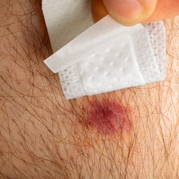 The image shows a close-up view of a person's skin with a small red and inflamed area, which appears to be a spider bite. A bandage is being gently peeled off, revealing the bite mark underneath. The surrounding skin is slightly reddened, indicating irritation or a mild reaction to the bite.

